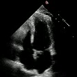 Single observed echocardiography frame